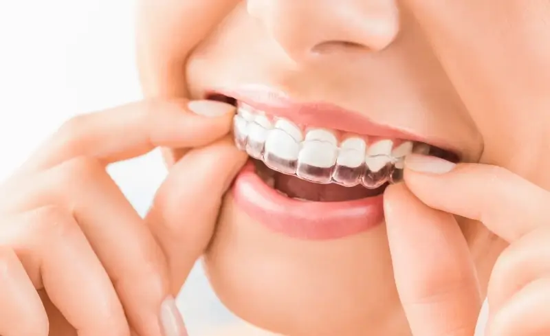 Invisalign skuteczność