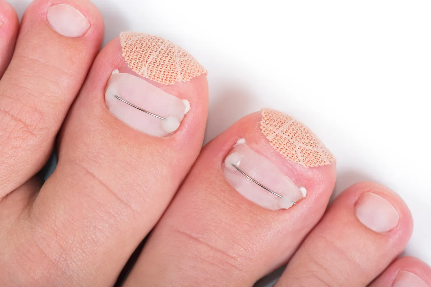 Pedicure leczniczy